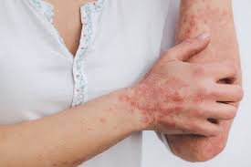 List of Psoriasis Ayurvedic Medicine in India